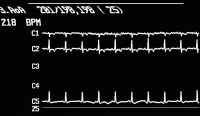 stenecg1.gif